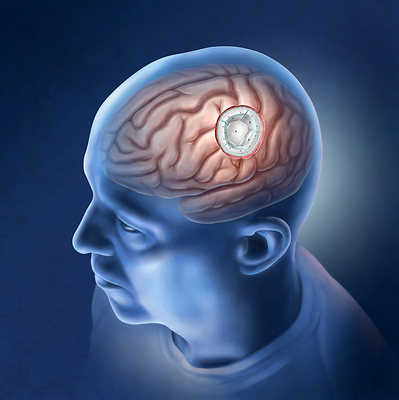 GammaTile Tile-Based Radiation Therapy