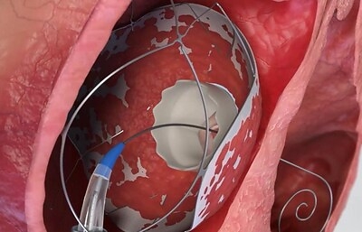 TruLeaf Medical Expands First-in-Human Clinical Program: Successfully Implants Breakthrough RoseDoc™ Platform via Pure Percutaneous Access