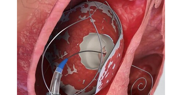TruLeaf Medical Expands First-in-Human Clinical Program: Successfully Implants Breakthrough RoseDoc™ Platform via Pure Percutaneous Access