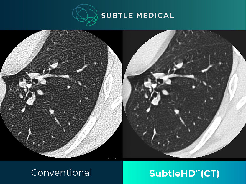 Subtle Medical Receives FDA Clearance for SubtleHD™(CT), Expanding AI ...