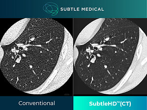 Subtle Medical Receives FDA Clearance for SubtleHD™(CT), Expanding AI-Powered Image Enhancement into CT Imaging