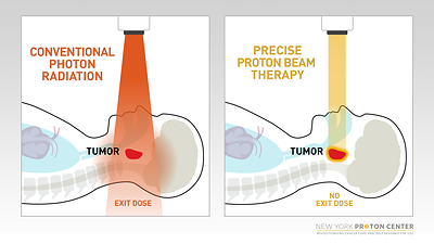 Proton therapy precisely targets tumors while minimizing radiation exposure to surrounding healthy tissues and critical organs. Unlike conventional photon radiation, proton beams can be customized to travel to a specified depth in the body and then stop. Nearly all of the radiation is deposited directly into the tumor, with no exit dose, resulting in fewer side effects.