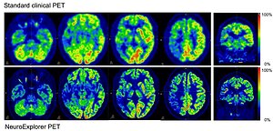 UZ and KU Leuven: NeuroEXPLORER PET makes detection of early phases of diseases possible