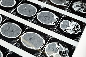 Cerebral Palsy Guide Releases Updated Guidance on Transitioning to Adult Healthcare
