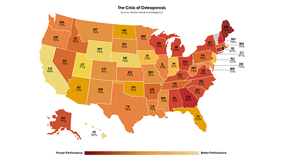 A new analysis by Motive Medical Intelligence, based on more than 100 million U.S. insurance claims, reveals alarming gaps in osteoporosis treatment after fragility fractures. Despite widely accepted standards of care guidelines calling for diagnosis and treatment following fractures linked to bone loss, most women in every state go untreated. A new analysis by Motive Medical Intelligence, based on more than 100 million U.S. insurance claims, reveals alarming gaps in osteoporosis treatment after fragility fractures. Despite widely accepted standards of care guidelines calling for diagnosis and treatment following fractures linked to bone loss, most women in every state go untreated.