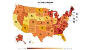 Osteoporosis Crisis in America: New National Study Reveals Clinicians Are Failing Millions of Women After Bone Fragility Fractures