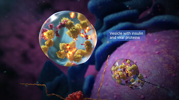 Beta cells overwhelmed, producing insulin and viral proteins simultaneously