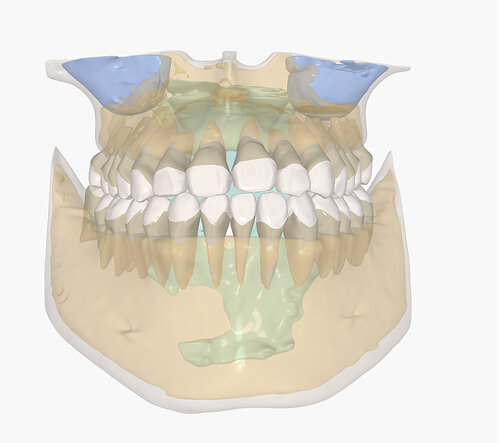 IRS (Intelligent Root System) Gold provides detailed 3D visualizations of cortical and cancellous bone, maxillary sinus, and airway structures for more comprehensive case evaluation IRS (Intelligent Root System) Gold provides detailed 3D visualizations of cortical and cancellous bone, maxillary sinus, and airway structures for more comprehensive case evaluation