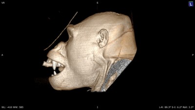 3D CT scan of gorilla Mizani's skull