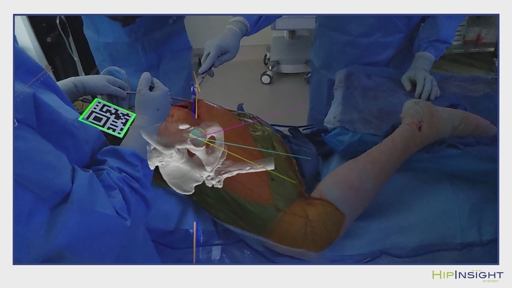 Surgical Planning Associates Announces Open Platform Access to the HipInsight System® Enabling Technology Platform