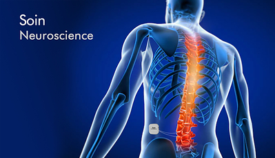 Pictured: Rendering of a Soin Neuroscience Spinal Cord Stimulation Implant