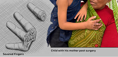 (L) Toddler's severed fingers after the accident & (R) Boy with his mother post finger-reconstruction surgery
