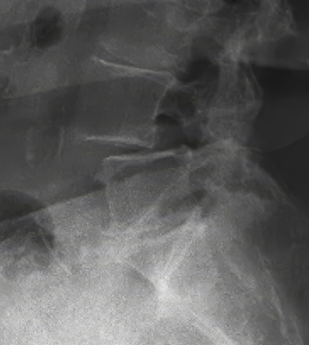 Luna Ti Pre-Op image - Spinal Elements