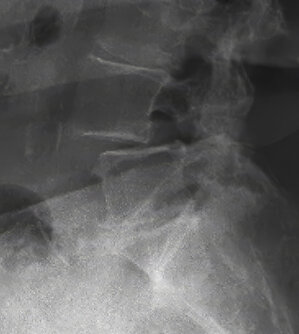 Spinal Elements Launches Luna® Ti