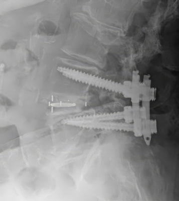 Luna Ti Post-Op image - Spinal Elements