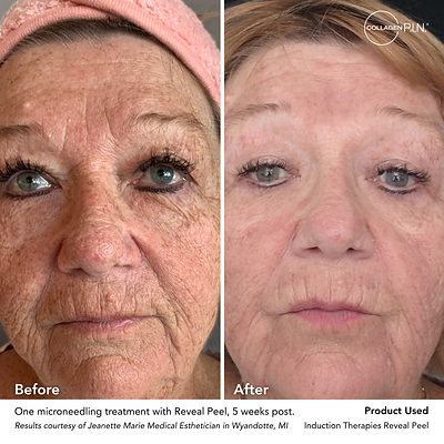 Collagen P.I.N.® Announces Winners of the 2026 Transformation Awards Celebrating Outstanding Microneedling Results