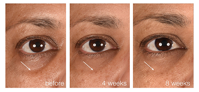 Rebuild Hollow Undereyes by 129%* with Smart Eye Density