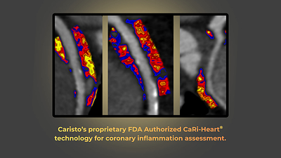 Caristo’s proprietary FDA Authorized CaRi-Heart® technology for coronary inflammation assessment.