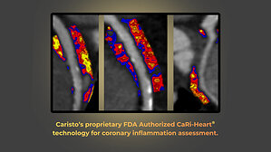 Caristo Diagnostics' CaRi-Heart® Coronary Inflammation Technology Authorized by U.S. FDA