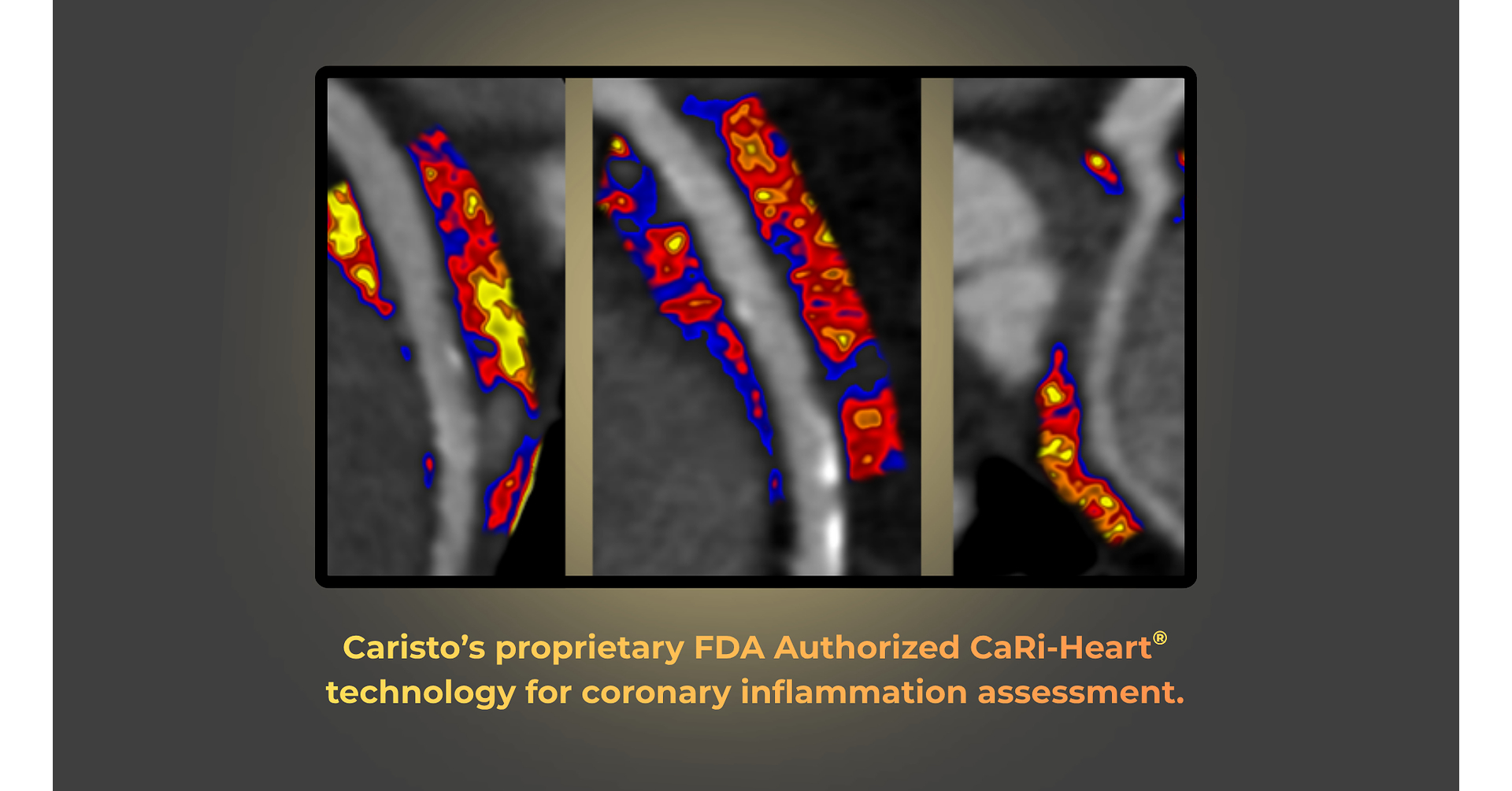 Caristo Diagnostics' CaRi-Heart® Coronary Inflammation Technology ...