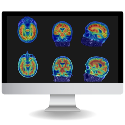 Cortechs.ai Announces FDA Clearance for NeuroQuant® PET: Advancing Molecular Imaging for Cognitive Impairment