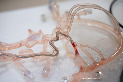 Johnson and Johnson Thrombectomy 