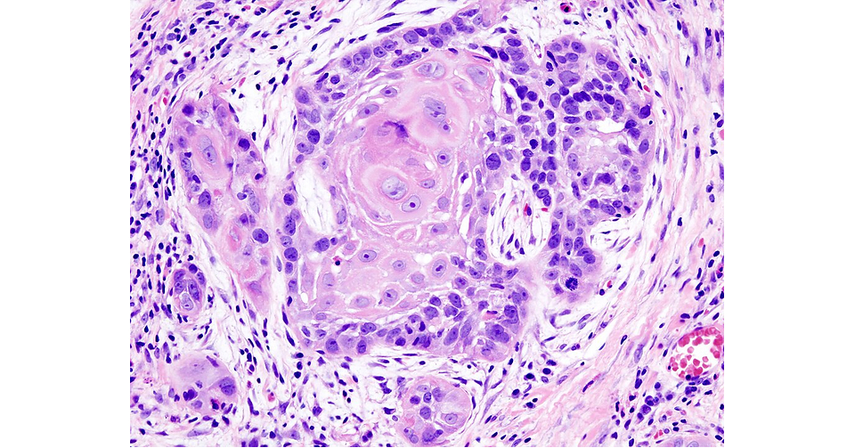 Mapping Smarter Drug Delivery for Treating Oral Cancers: A Hasanuddin University Review