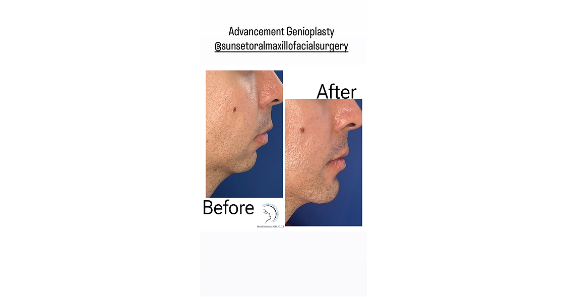 Los Angeles Oral and Maxillofacial Surgeon Dr. David Salehani Uses Genioplasty (chin surgery) to Address Facial Balance at the Skeletal Level
