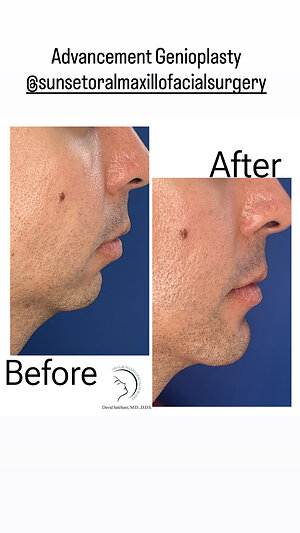 Los Angeles Oral and Maxillofacial Surgeon Dr. David Salehani Uses Genioplasty (chin surgery) to Address Facial Balance at the Skeletal Level