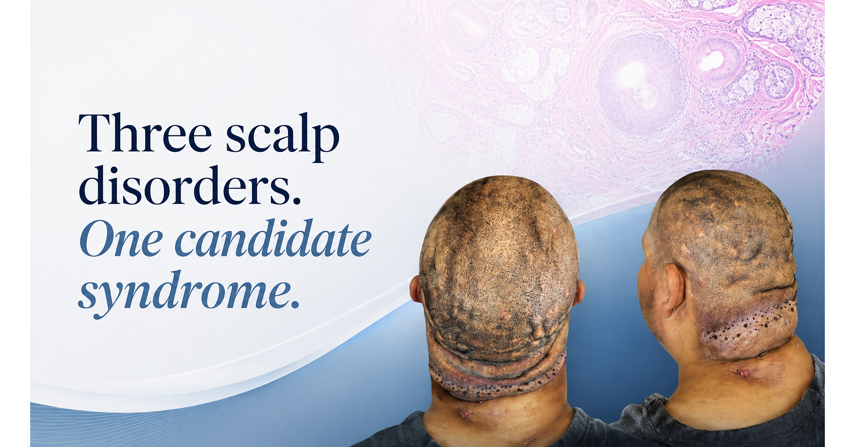 Three Scalp Conditions May Point to a Single Syndrome, New Study Finds