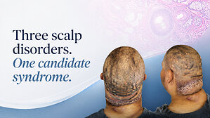Three Scalp Conditions May Point to a Single Syndrome, New Study Finds