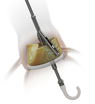 CardiacPICUスタンダード Medtronic Announces Strategic Investment in Pi-Cardia to