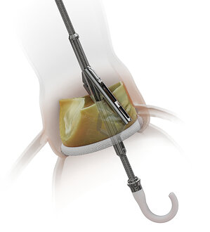 Medtronic Announces Strategic Investment in Pi-Cardia to Accelerate Innovation for Complex TAVR