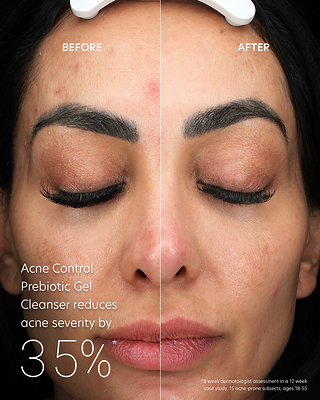Before and after results from using PCA Skin's Acne Prebiotic Gel Cleanser.