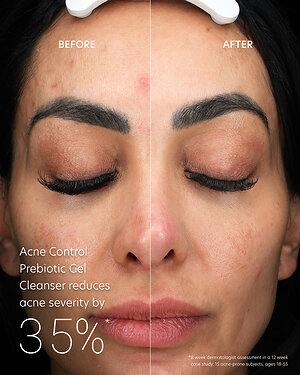 PCA SKIN® Redefines Acne Care with New Acne Control Prebiotic Gel Cleanser