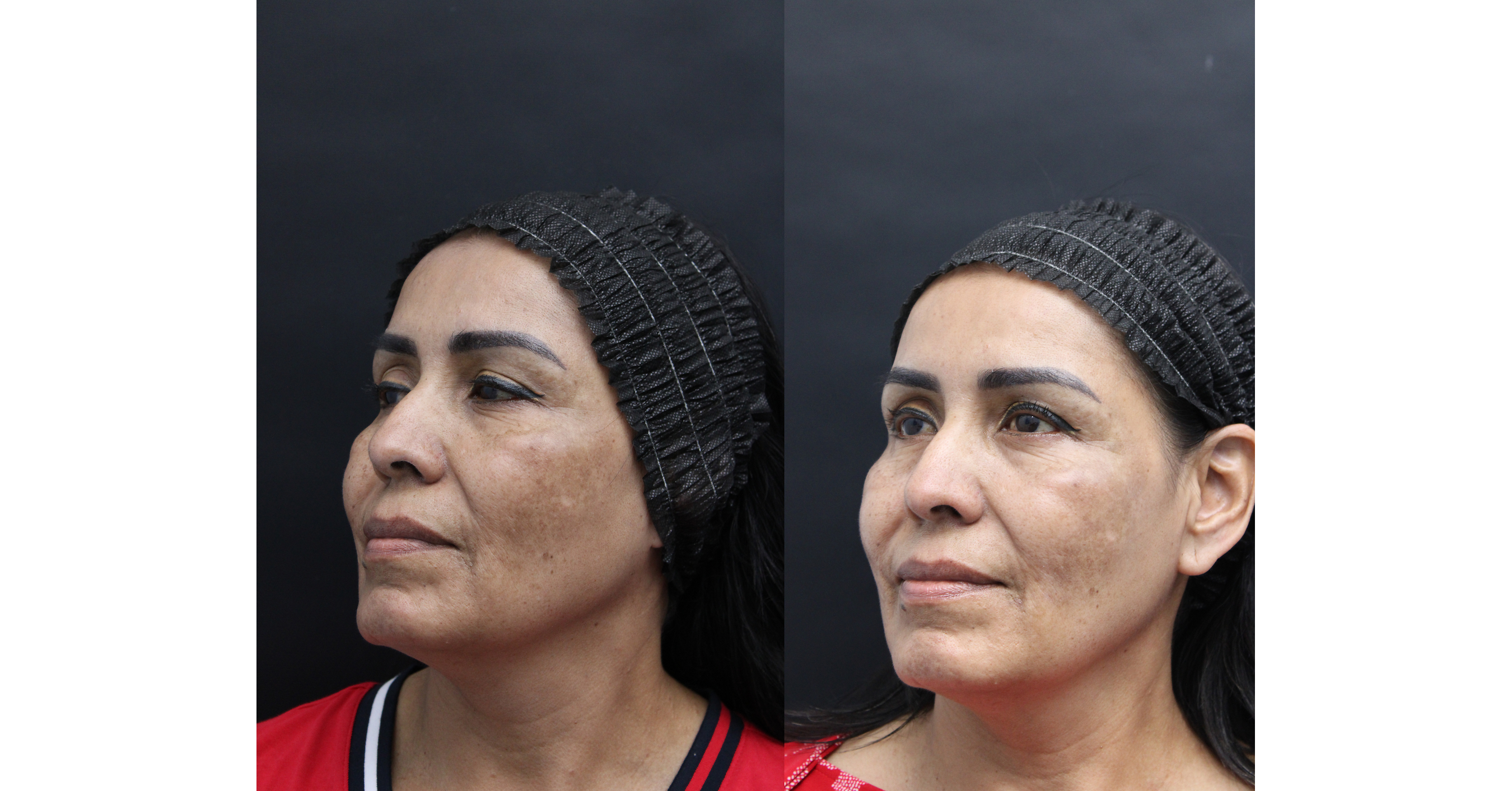 New Clinical Findings Show Promising Improvement in Melasma in Fitzpatrick V Skin