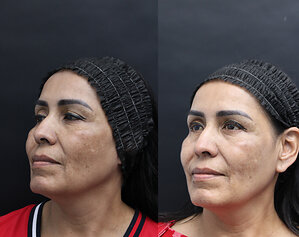 New Clinical Findings Show Promising Improvement in Melasma in Fitzpatrick V Skin