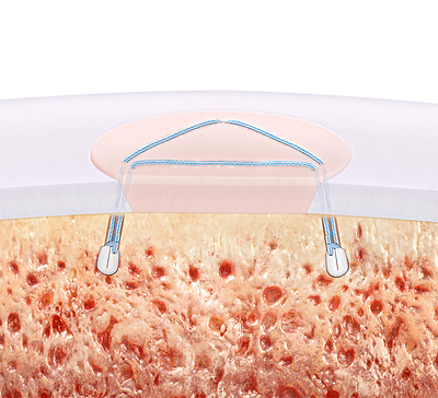 The collaboration with ICRS comes as Arthrex continues to expand its joint preservation portfolio. Recent advancements include the launch of the ChondralTak™ technique, the first new cartilage fixation device to be introduced to the market in 23 years, and patient-specific 3D-printed guides designed to support knee osteotomy procedures.