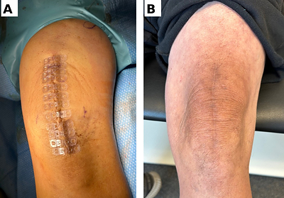 100 Consecutive Sports Medicine Cases, Zero Documented Wound Complications With Brijjit® Tissue Bridges