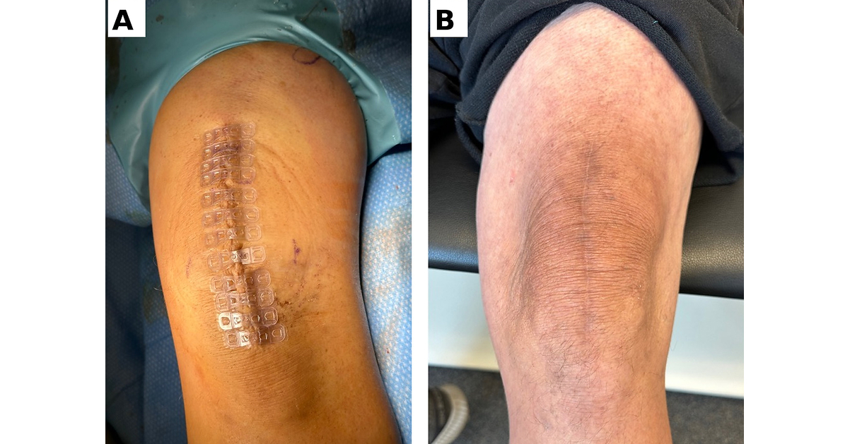 100 Consecutive Sports Medicine Cases, Zero Documented Wound Complications With Brijjit® Tissue Bridges