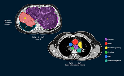 A Right-Sided Heart, A 3kg Tumour: A Rare Surgery at Zydus Hospital, Ahmedabad Gives An 11-Year-Old a New Life
