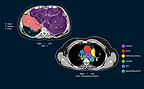 A Right-Sided Heart, A 3kg Tumour: A Rare Surgery at Zydus Hospital, Ahmedabad Gives An 11-Year-Old a New Life tumour A Right-Sided Heart, A 3kg Tumour: A Rare Surgery at Zydus Hospital, Ahmedabad Gives An 11-Year-Old a New Life Image for PR