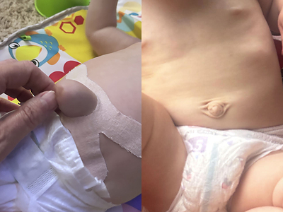 Before and after Navel Cradle. Before and after Navel Cradle.