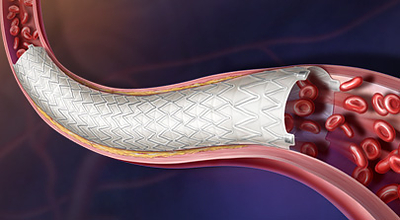 New AGILITY trial data presented at VIVA 2026 reinforce BD’s commitment to advancing peripheral vascular care. Nine-month results from the iliac cohort showed strong safety and effectiveness outcomes for the Revello™ Vascular Covered Stent, including 97.2% primary patency and 98.3% freedom from clinically driven target lesion revascularization. Together, these findings expand the growing body of evidence supporting innovative treatment options for patients with PAD.