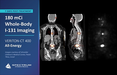 180 mCi Whole-Body I-131 (Schneider Children's Medical Center) 180 mCi Whole-Body I-131 (Schneider Children's Medical Center)