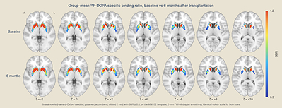 Gold-standard ¹⁸F-DOPA PET molecular imaging from the Phase I data demonstrates elevated tracer uptake at the transplant site, confirming a region-specific increase in cerebral dopamine synthesis and metabolic capacity following XS411 treatment.