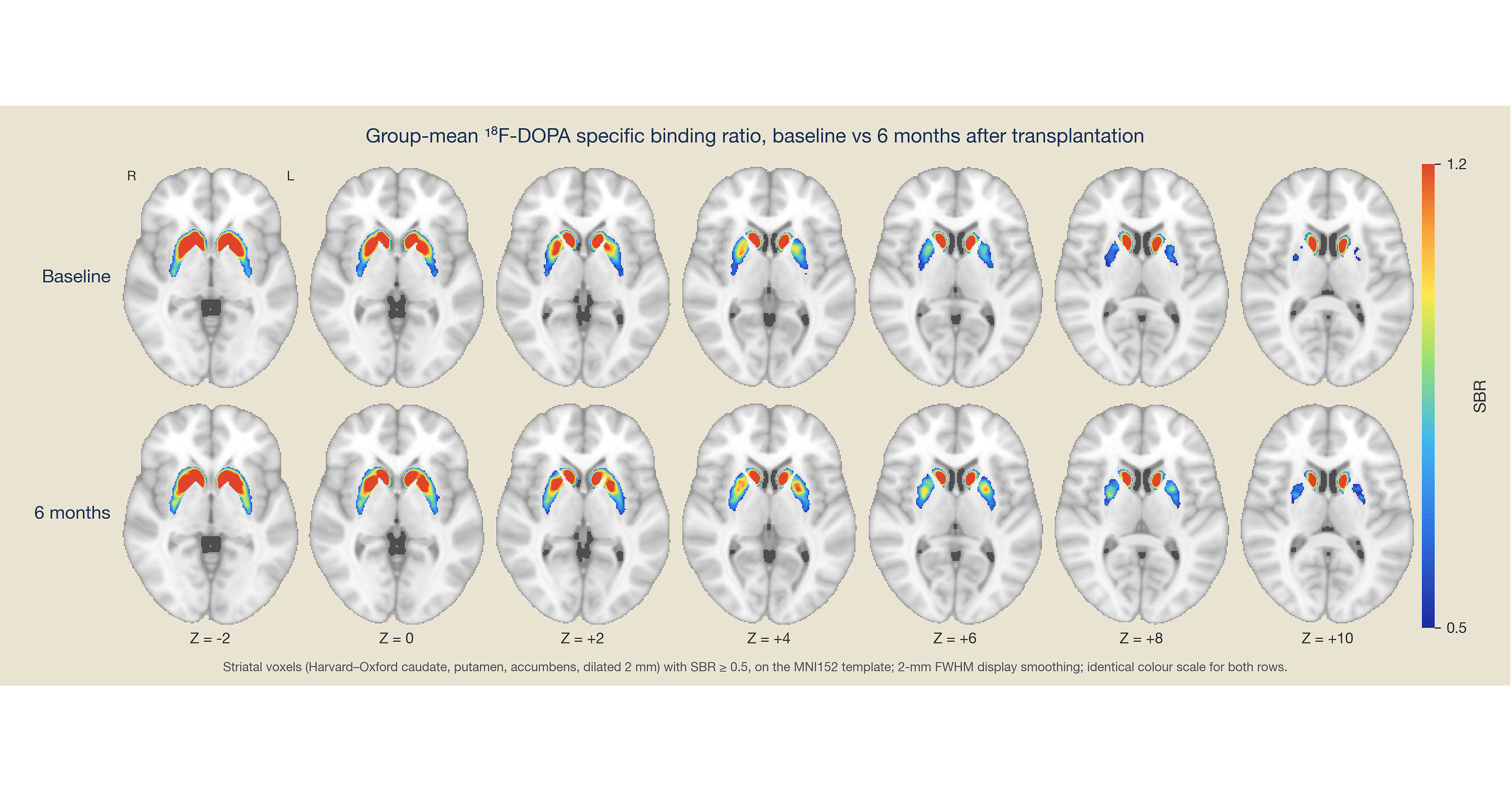 New Progress -- XellSmart Unveiled Phase I Results of Off-the-Shelf Parkinsons Disease Cell Therapy at MDS & Completed Blinded Phase II Enrollment