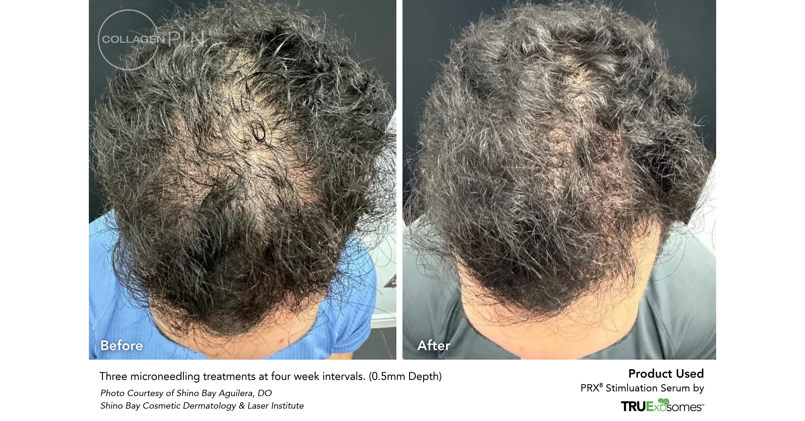 New Case Series Explores Plant-Derived Exosomes and Microneedling for Hair Loss