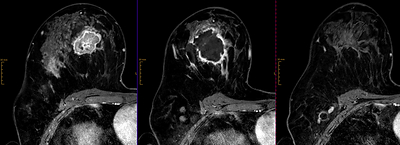 MRI images at 3 timepoints for one Cohort A patient who had 2 injections. This patient achieved a radiological and pathological complete response (CR).