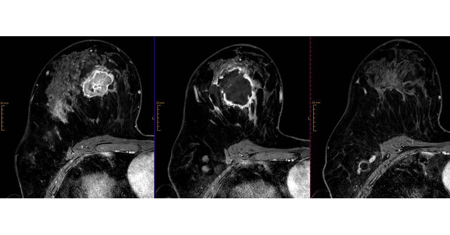 Intensity Therapeutics, Inc. to Present INVINCIBLE-4 Neoadjuvant Triple-Negative Breast Cancer Study Data for the First Seven (7) Patients After INT230-6 Treatment (Cohort A) in an ePoster Presentation at the European Society of Medical Oncology (ESMO) Meeting